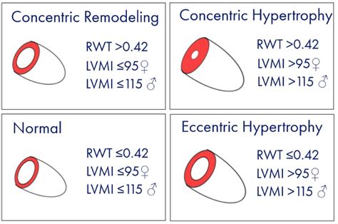 lvmi rwt calculator - Lv Mass Index: The Key for Cardiac Health Monitoring .